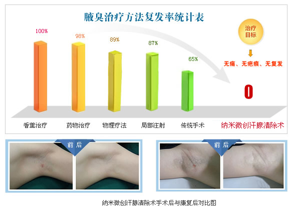 最新关于狐臭的研究与探讨